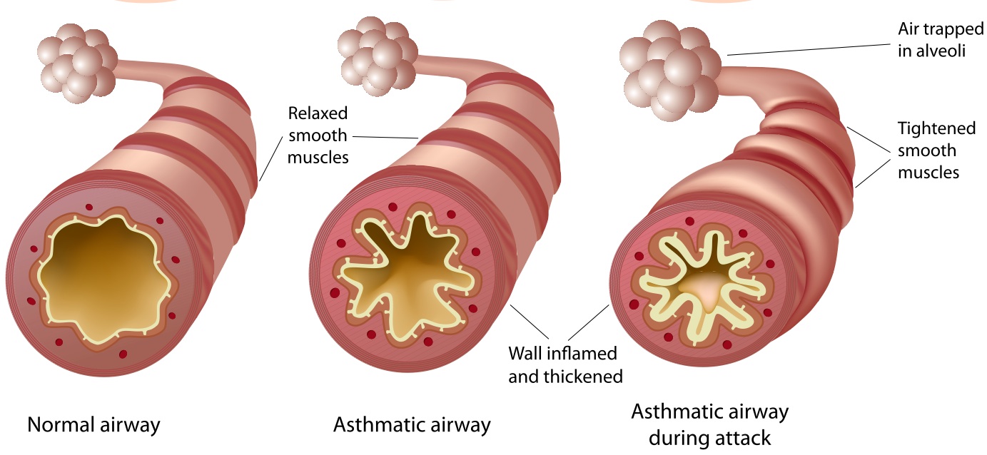 set asthma shaklee