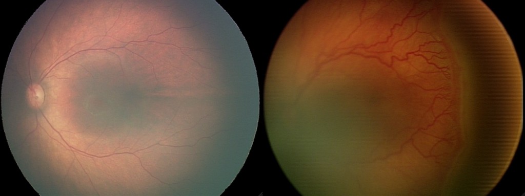 A health retina (L) versus a retina showing retinopathy of prematurity