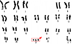 Researchers have silenced the third copy of chromosome 21, at least in a dish. What might this mean for Down syndrome? (Wikimedia Commons)