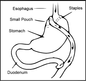 Diagram of Roux-en-Y gastric bypass