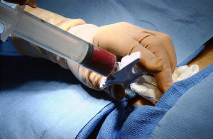 Bone marrow being extracted for a hematopoietic stem cell transplant