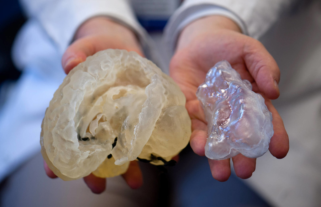 3D printed plastic model of a patient's brain Joseph Madsen epilepsy