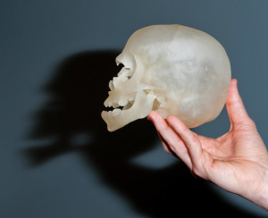 3D printed plastic model of a patient's skull John Meara craniofacial anomalies