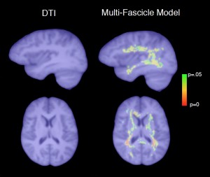 MRI images showing isotropic diffusion in autism