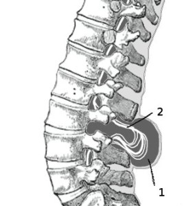 spina bifida myelomeningocele