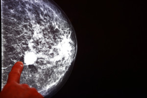 Breast cancer cholesterol ezetimibe Zetia angiogenesis